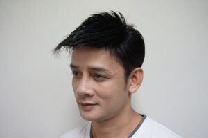 หลังรับการทอผมแก้ปัญหาผมบาง